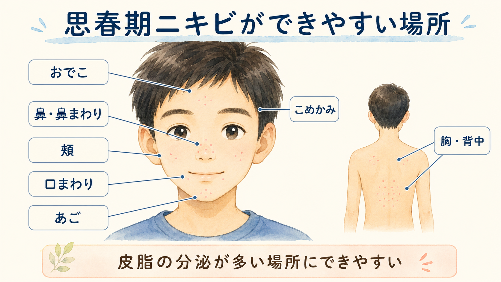 思春期ニキビができやすい場所
